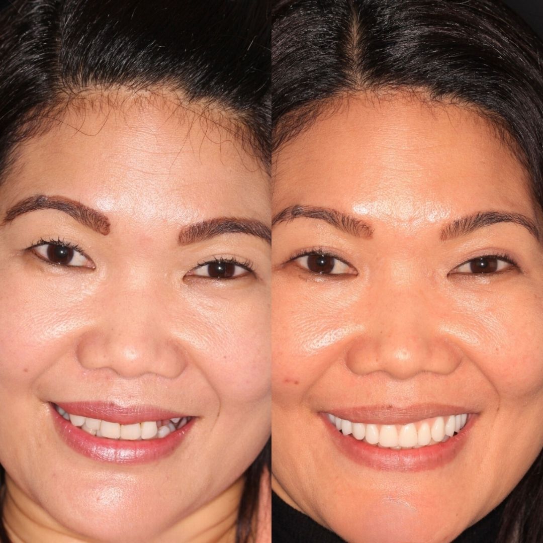 Before and after dental implant treatment with Nik Vourakis